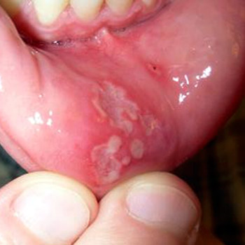 mouth ulcers and vitamin deficiency