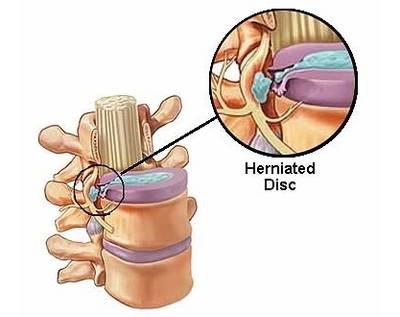 herniated disc symptoms picture