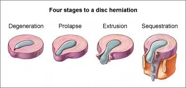 herniated disc and shoulder pain