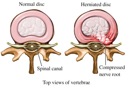 herniated disc symptoms