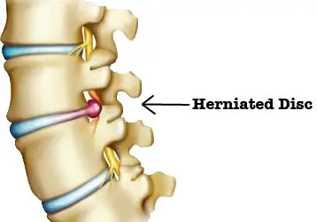 herniated disc symptoms