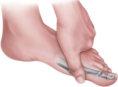 foot pain after running