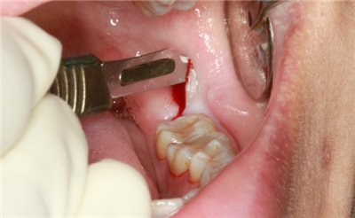 wisdom tooth removal gum infection