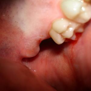 gum infection pictures symptoms