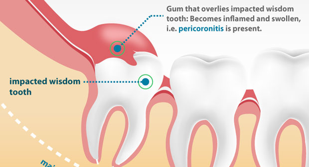 bad breath and taste after wisdom teeth extraction