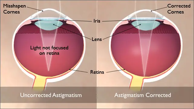 astigmatism correction surgery