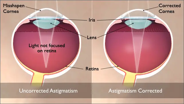 6 Astigmatism Correction 