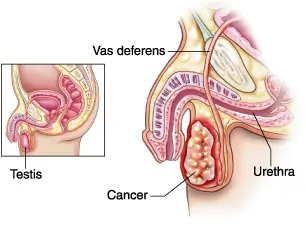 testicular cancer untreated for years picture