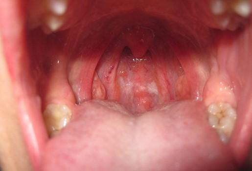 Green Spots On Throat 79