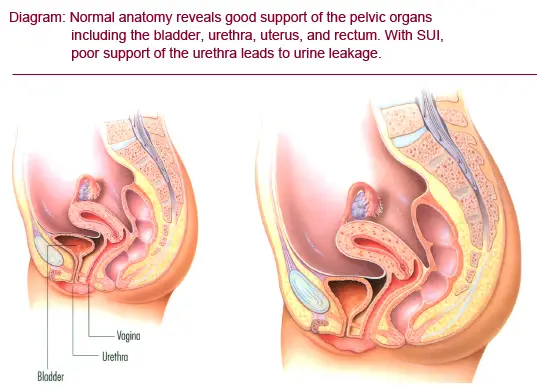 pressure on bladder cancer