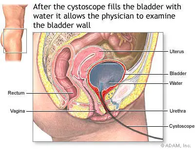 pressure on bladder causing frequent urination