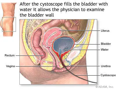 what causes pressure on bladder