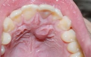 Roof of Mouth Hurts: Causes and Treatment | IYTmed.com