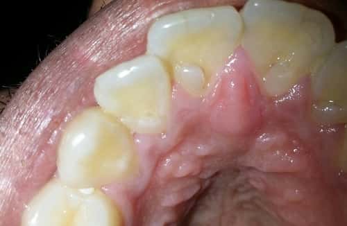 Roof of Mouth Hurt