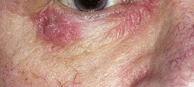 eczema under eyes pictures