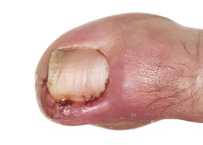 toenail pain when pressed