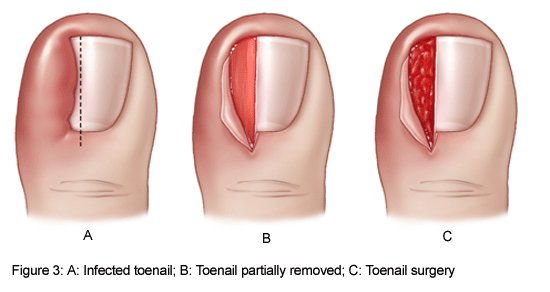toenail pain from shoes