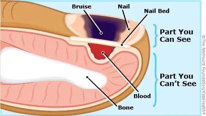 toenail pain from fungus