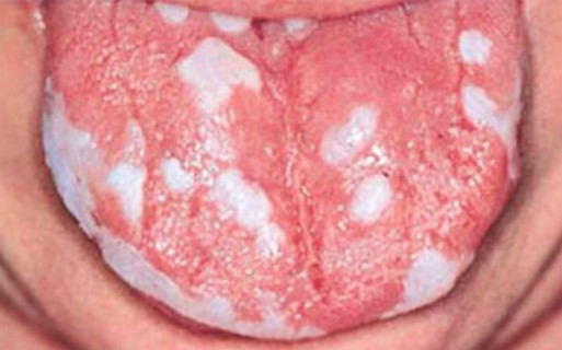 white spots on tongue cancer