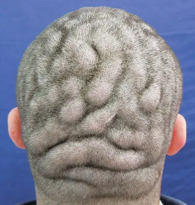 scalp hurts brain tumor