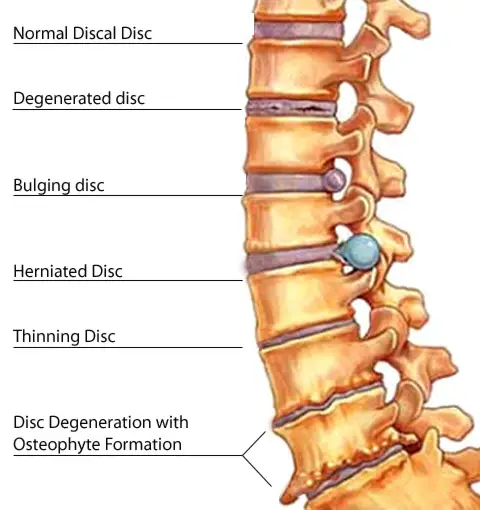 severe lower back pain and headache