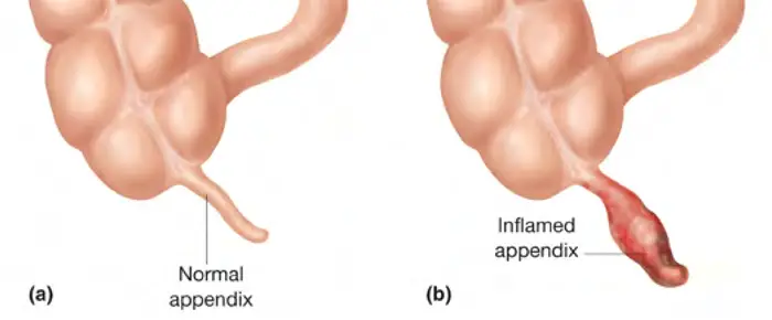 symptoms of appendix about to burst