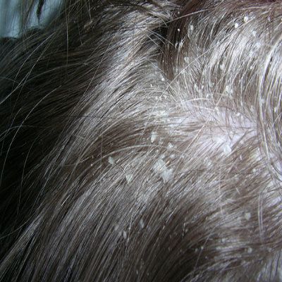 scalp hurts when hair is dirty