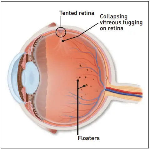 flashing light in eye and headache