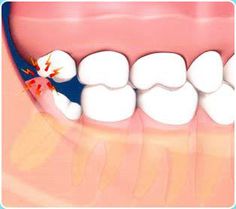 teeth translucent pain gums swollen