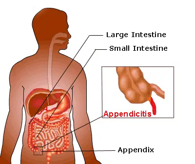 symptoms of appendicitis and location