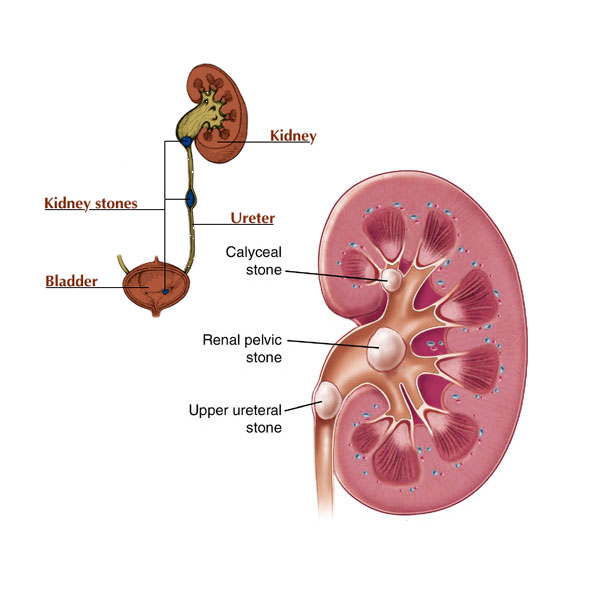 kidney stones pain