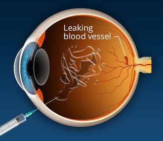 Macular Degeneration Treatment macugen