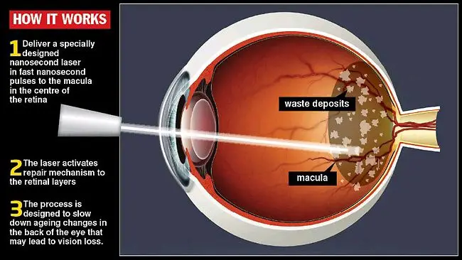 Visudyne drug treatment