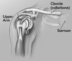 clavicle fracture symptoms