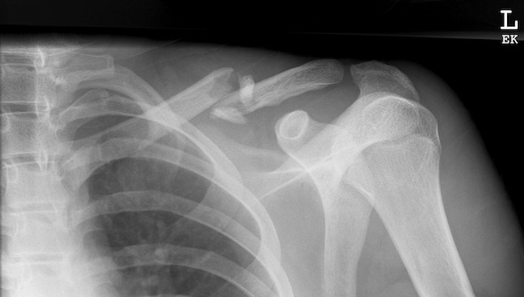 Clavicle fracture before surgery x-ray
