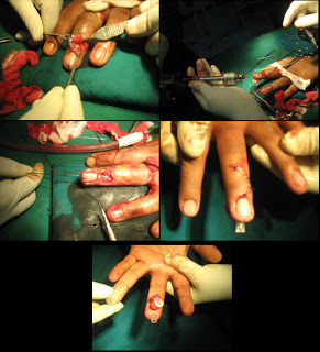 Mallet finger surgery
