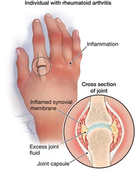 rheumatoid arthritis news