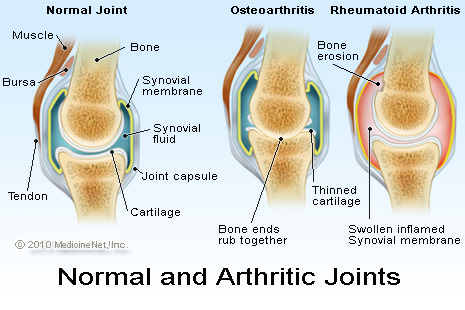 rheumatoid arthritis and osteoarthritis