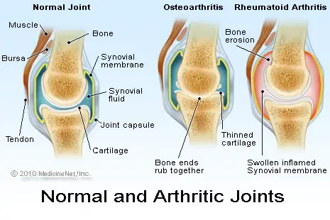 rheumatoid arthritis and osteoarthritis