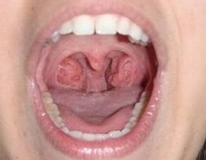 signs tonsils need to be taken out