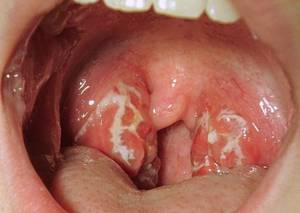 throat polyps removal