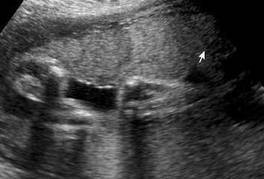 posterior placenta pictures