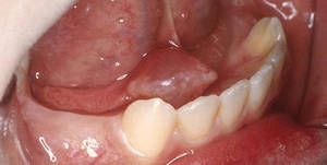 salivary gland infection antibiotics