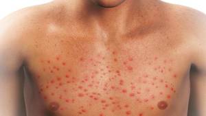 itching all over the body with red bumps