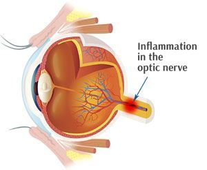 optic neuritis and lyme disease
