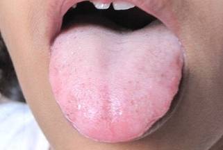 Why is My Tongue White When I Wake Up | IYTmed.com