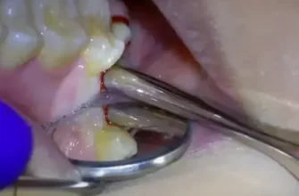 White Stuff in Wisdom Tooth Socket