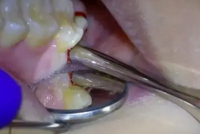 White Stuff in Wisdom Tooth Socket