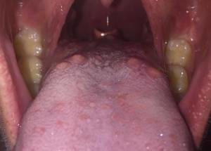 bumps in throat and back of tongue