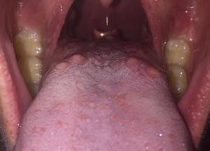 Main Causes Of Large Bumps On Back Of The Tongue IYTmed Com   76 Bumps On Back Of Tongue No Pain 